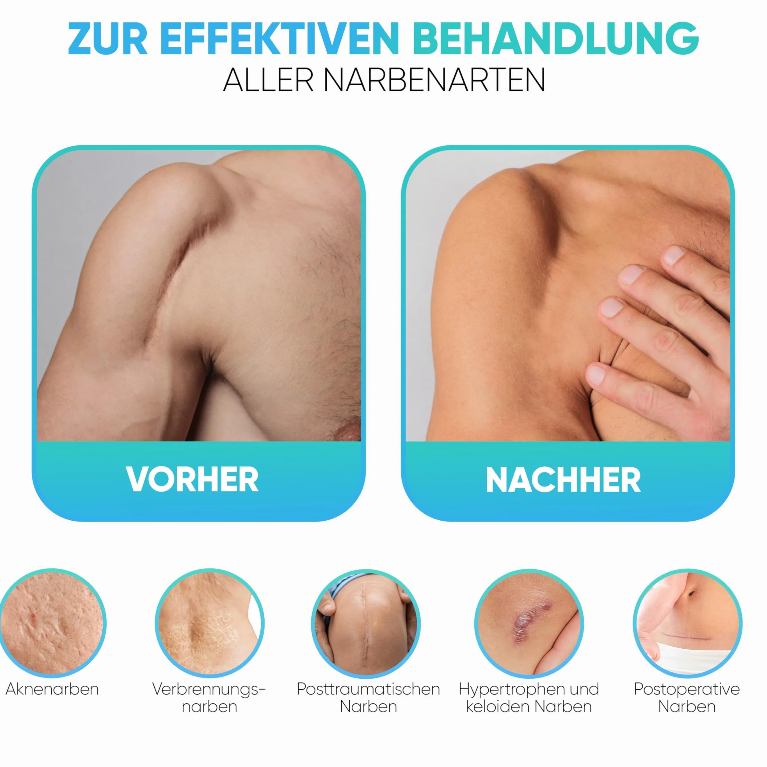 Health Press® Żel na blizny 20 ml zmniejsza widoczność blizn dla dorosłych i dzieci